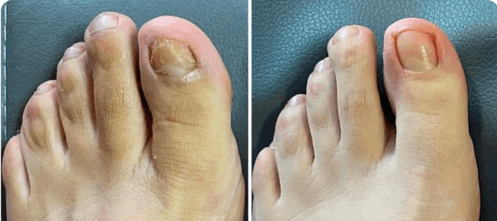 What is Orivelle Nail Fungus Pen