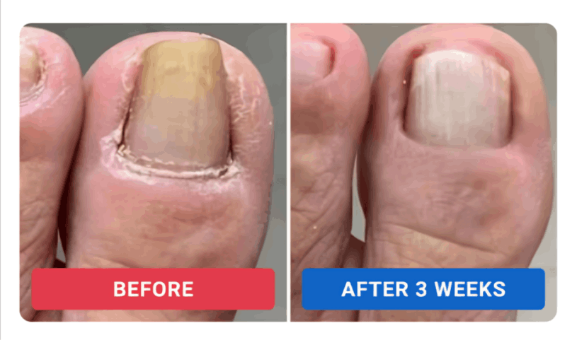 Orivelle Nail Fungus Pen users ~Dan R.