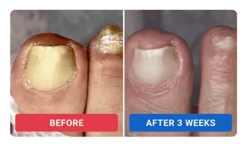 Orivelle Nail Fungus Pen users ~Elena S.