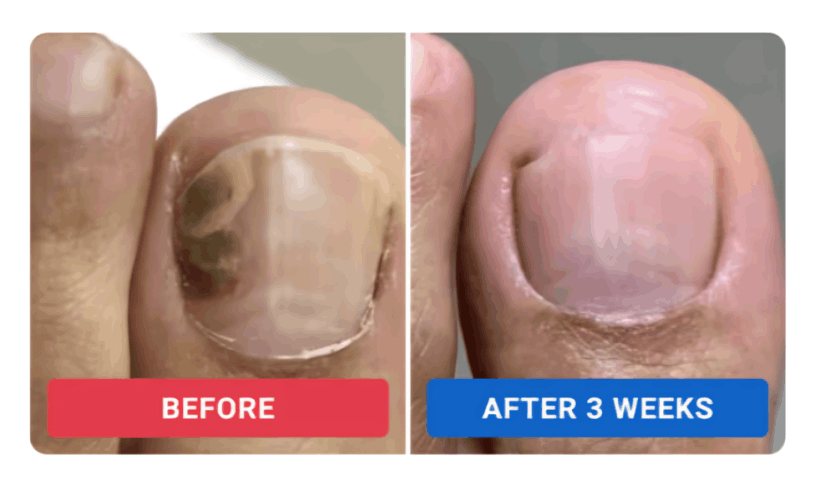 Orivelle Nail Fungus Pen users ~Rachel M.