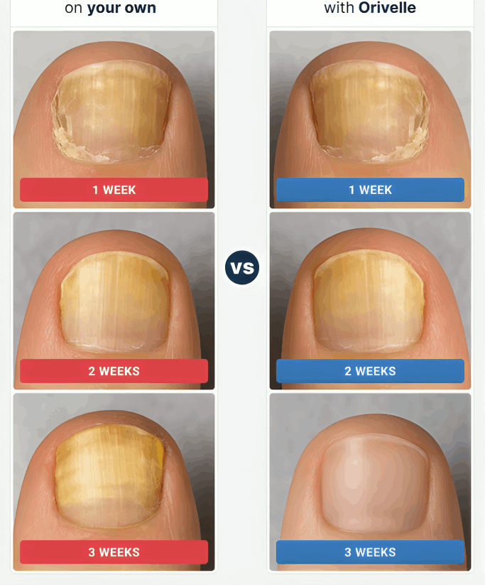 Orivelle Nail Fungus Pen